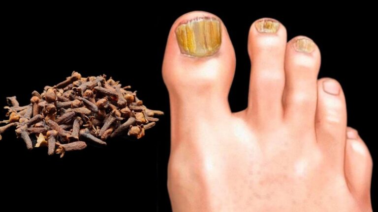 Dieser vergessene Trick mit Gewürznelken befreit dich sofort von Nagelpilz…