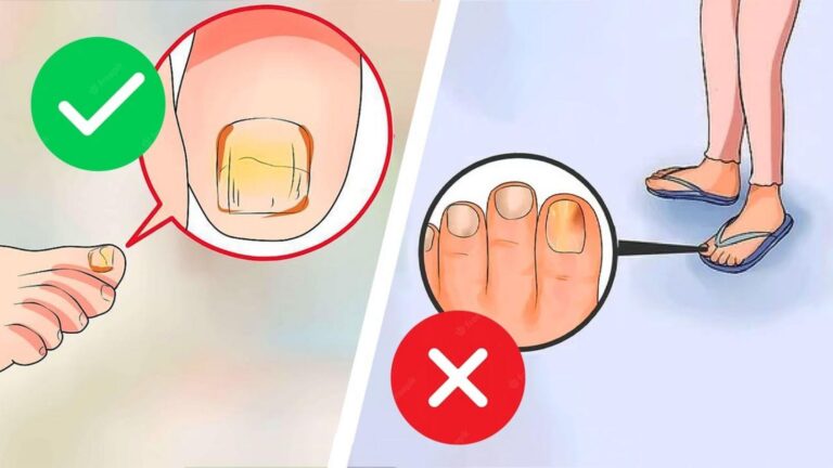 Dieser einfache Weg lässt Nagelpilz verschwinden und heilt deine Nägel nachhaltig…