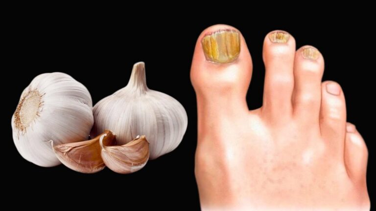 Ein alter Trick zur sofortigen Beseitigung von Nagelpilz – so einfach funktioniert’s…