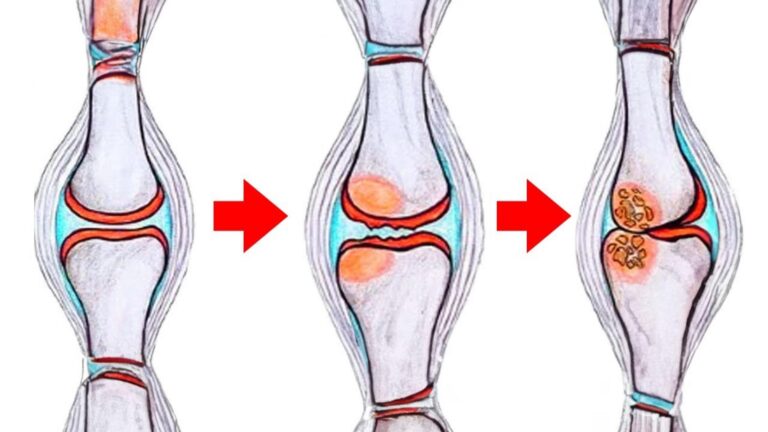 Diese Lebensmittel könnten deine Arthrose-Symptome deutlich lindern… entdecke sie jetzt!